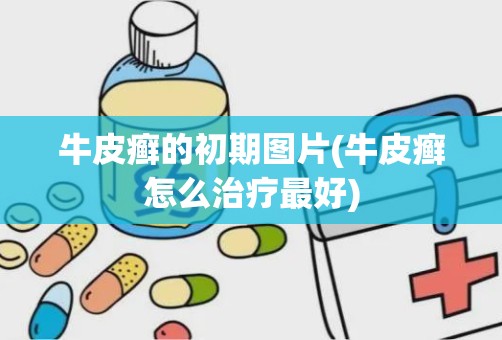 牛皮癣的初期图片(牛皮癣怎么治疗最好)